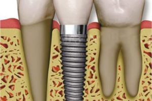 Interventions for replacing missing teeth: antibiotics at dental implant placement to prevent complications