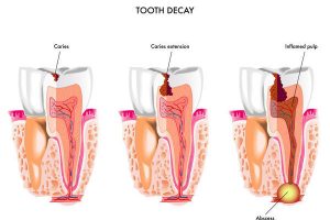 How to Stop Tooth Decay, Dental Caries