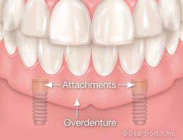 Implant Overdentures for the Lower Jaw