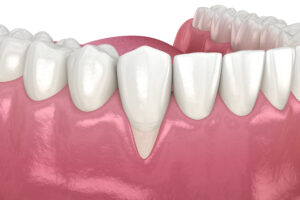 Understanding Gum Recessions: Causes and Solutions